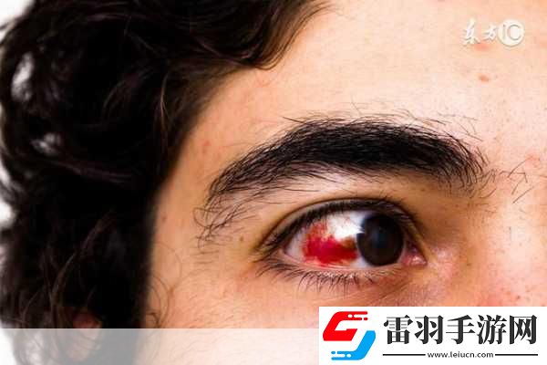 眼睛也會中風。