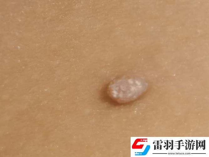 “皮下珠子”揭秘